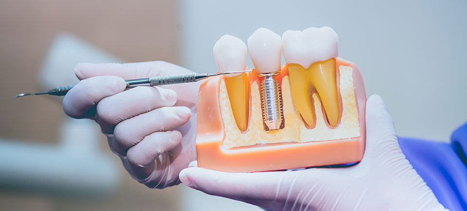Implantes Dentales
